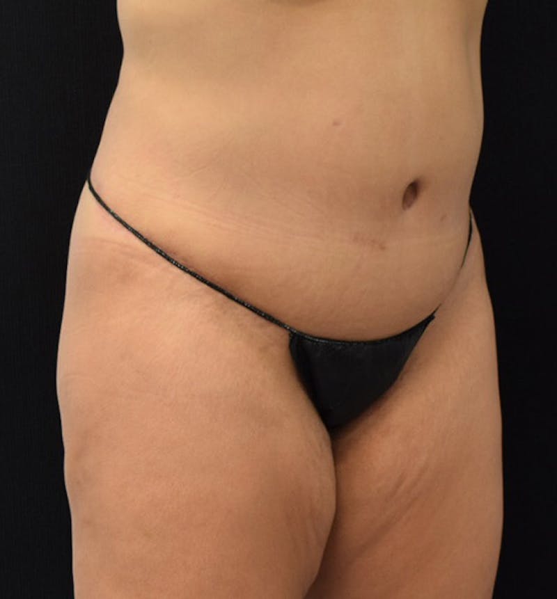 Lower Body Lift Before & After Gallery - Patient 101781872 - Image 4