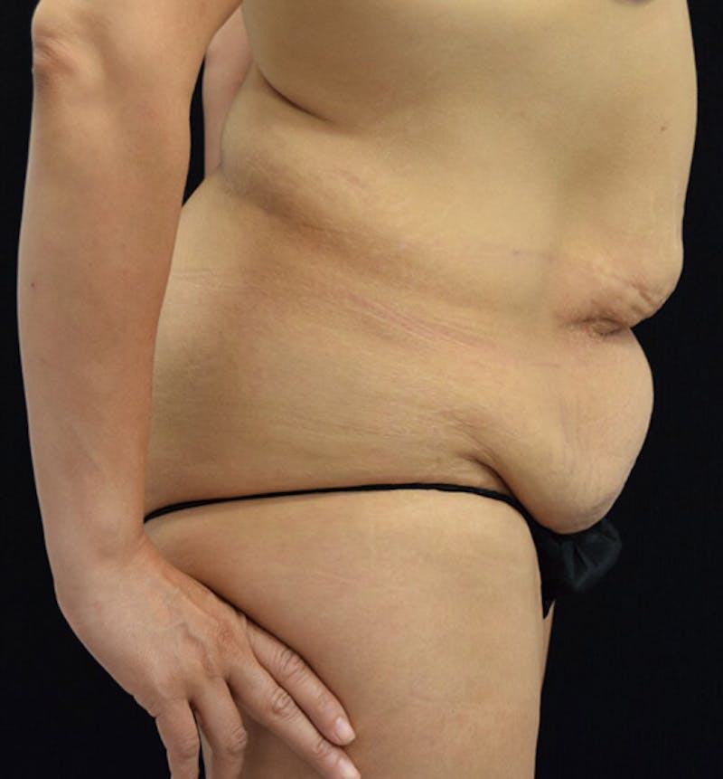 Lower Body Lift Before & After Gallery - Patient 101781872 - Image 5