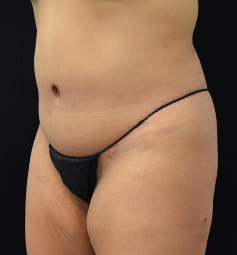 Lower Body Lift Before & After Gallery - Patient 101781872 - Image 8