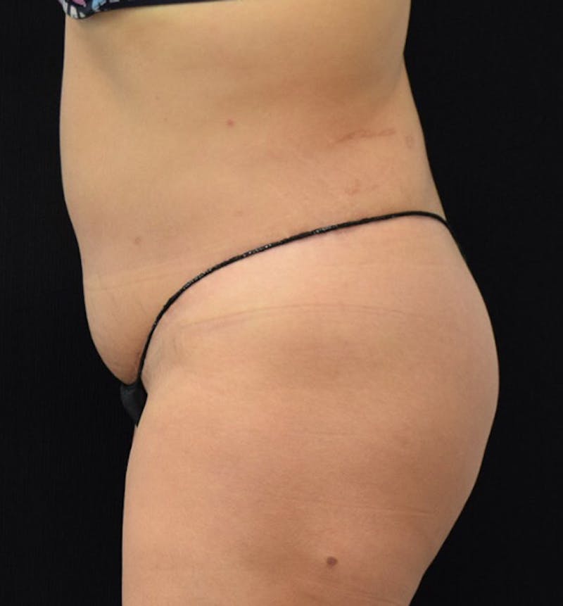 Lower Body Lift Before & After Gallery - Patient 101781872 - Image 10
