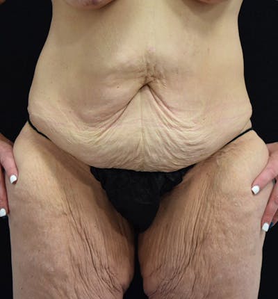 Lower Body Lift Before & After Gallery - Patient 101781873 - Image 1