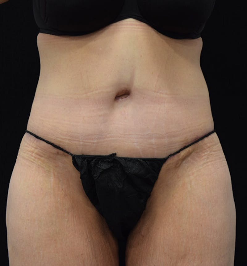 Lower Body Lift Before & After Gallery - Patient 101781873 - Image 2