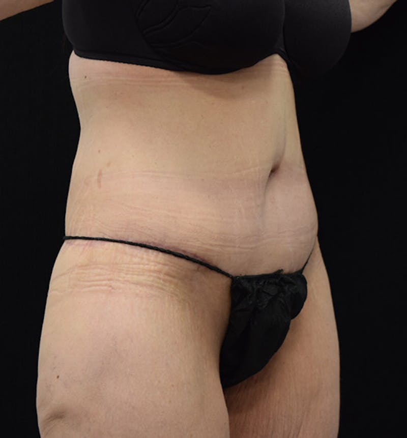 Lower Body Lift Before & After Gallery - Patient 101781873 - Image 4