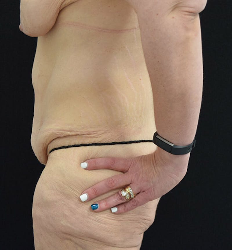 Lower Body Lift Before & After Gallery - Patient 101781873 - Image 5