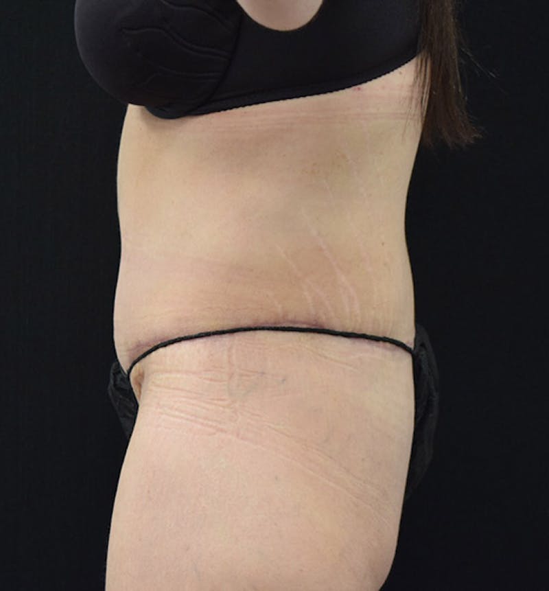 Lower Body Lift Before & After Gallery - Patient 101781873 - Image 6