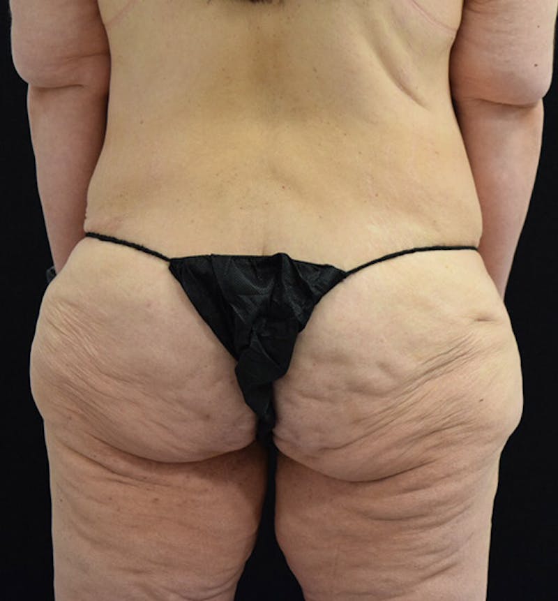 Lower Body Lift Before & After Gallery - Patient 101781873 - Image 7
