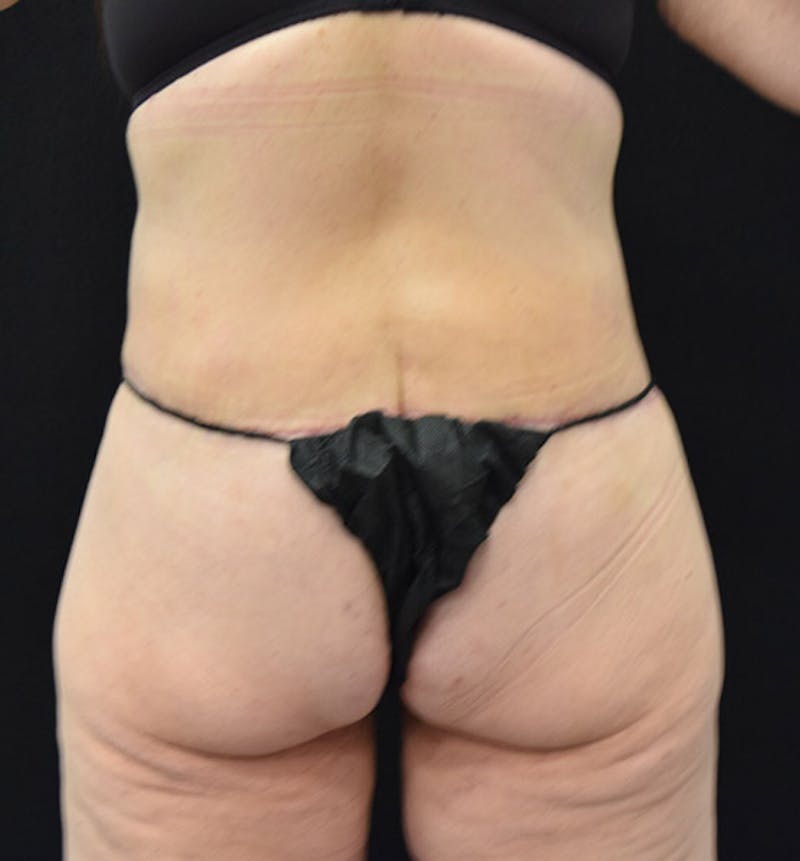 Lower Body Lift Before & After Gallery - Patient 101781873 - Image 8