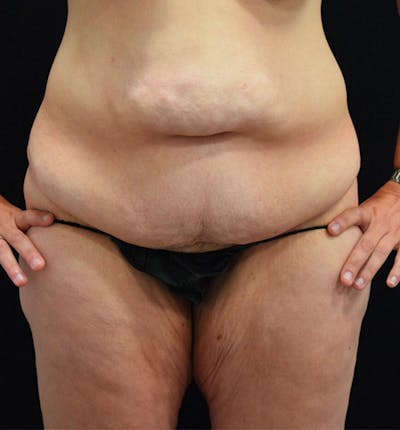 Lower Body Lift Before & After Gallery - Patient 102391197 - Image 1