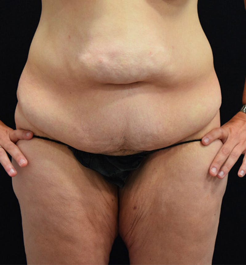 Lower Body Lift Before & After Gallery - Patient 102391197 - Image 1