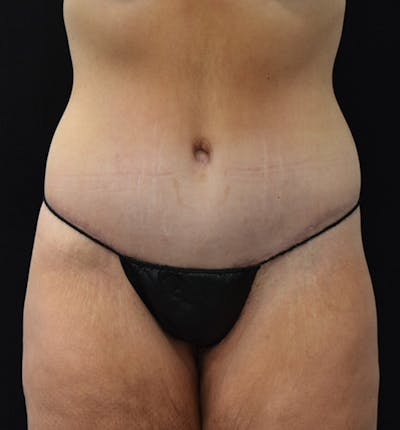 Lower Body Lift Before & After Gallery - Patient 102391197 - Image 2