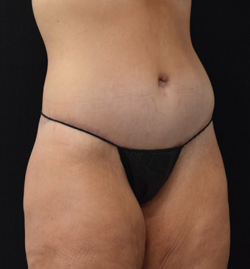 Lower Body Lift Before & After Gallery - Patient 102391197 - Image 4