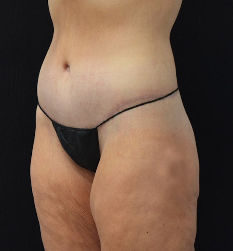 Lower Body Lift Before & After Gallery - Patient 102391197 - Image 6