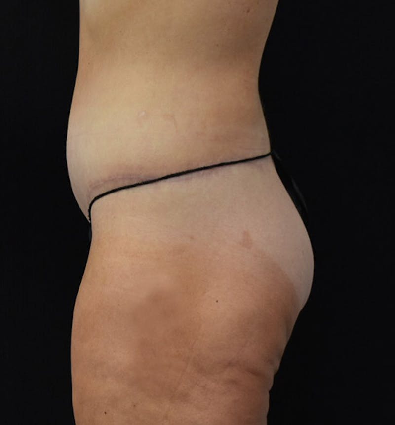 Lower Body Lift Before & After Gallery - Patient 102391197 - Image 8