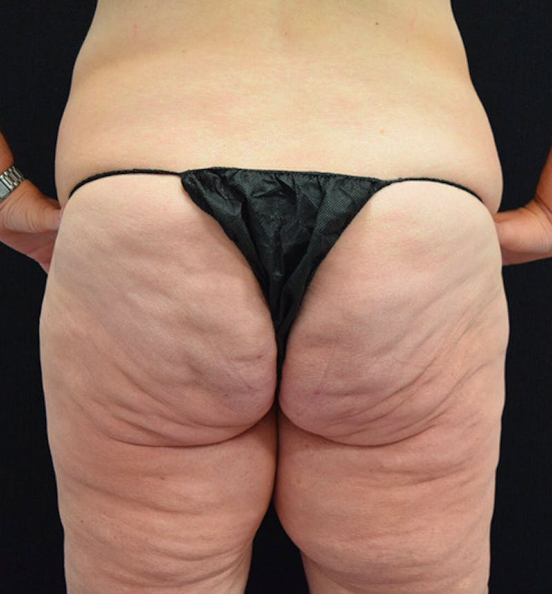 Lower Body Lift Before & After Gallery - Patient 102391197 - Image 9