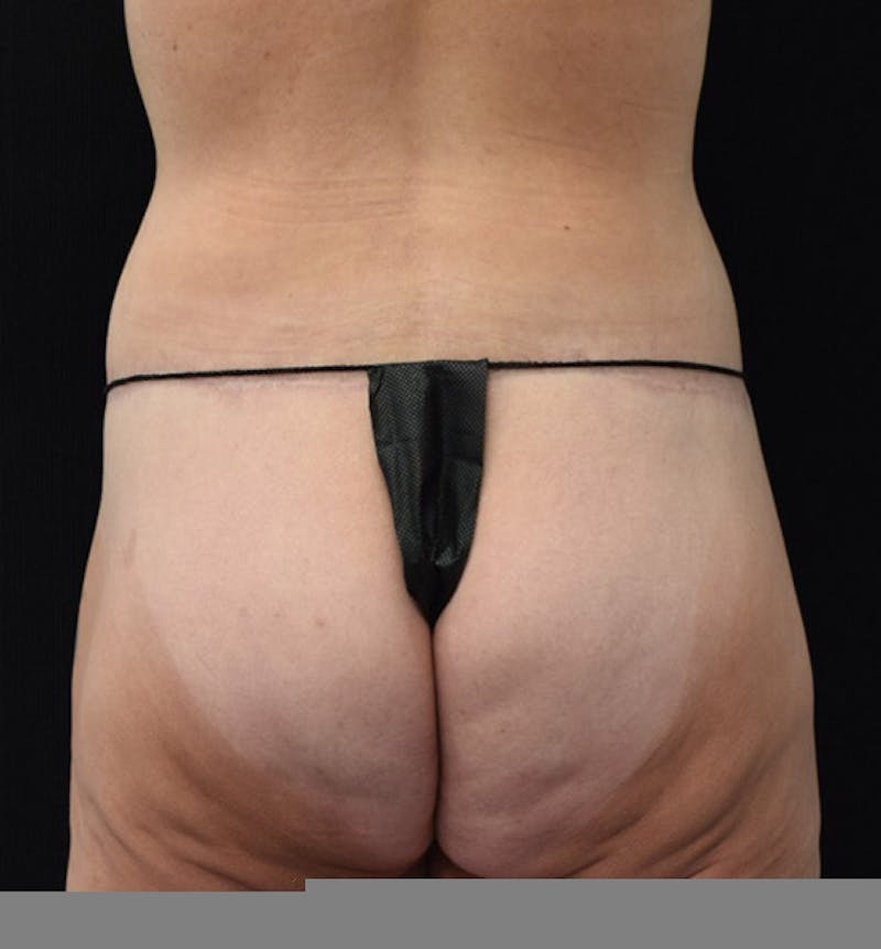 Lower Body Lift Gallery - Patient 102391197 - Image 10