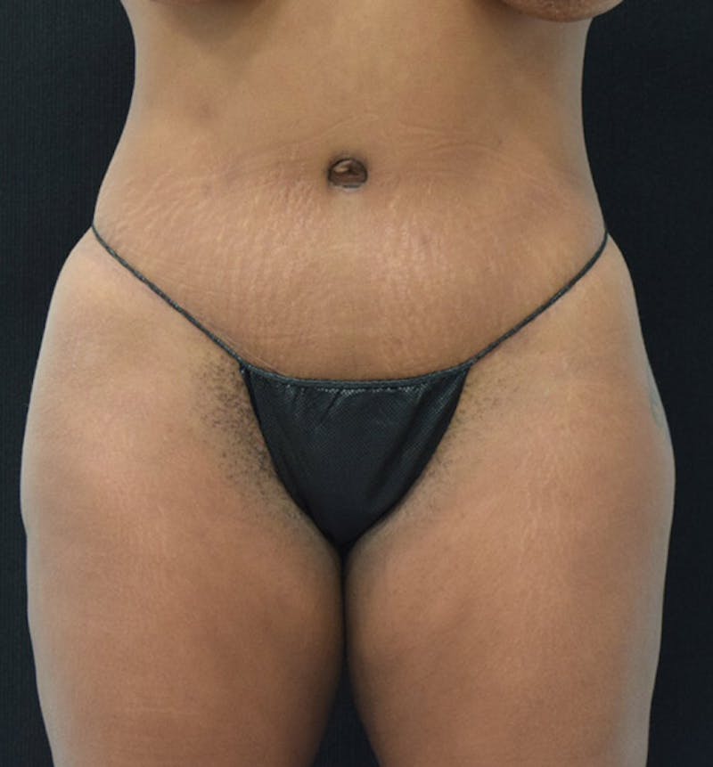 Lower Body Lift Before & After Gallery - Patient 102391249 - Image 2
