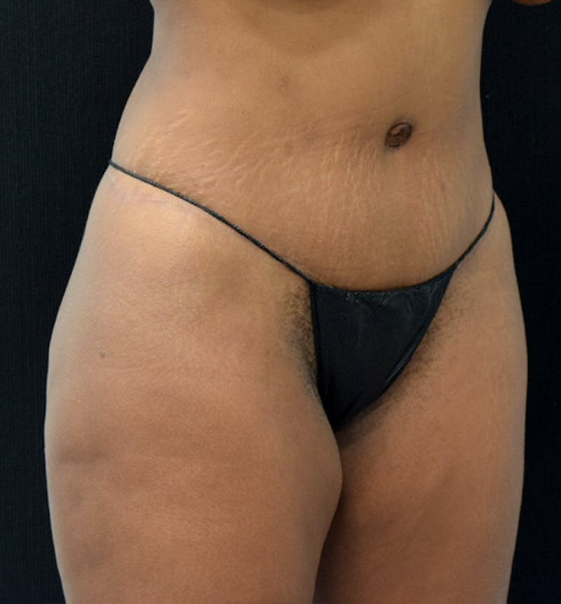 Lower Body Lift Gallery - Patient 102391249 - Image 4