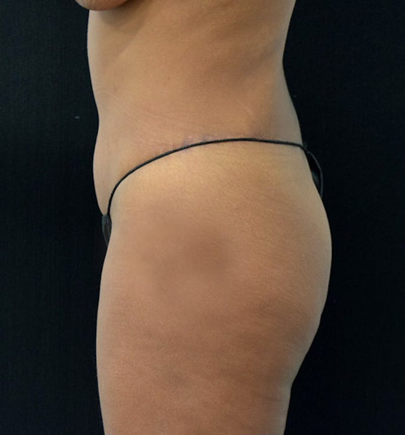 Lower Body Lift Before & After Gallery - Patient 102391249 - Image 6
