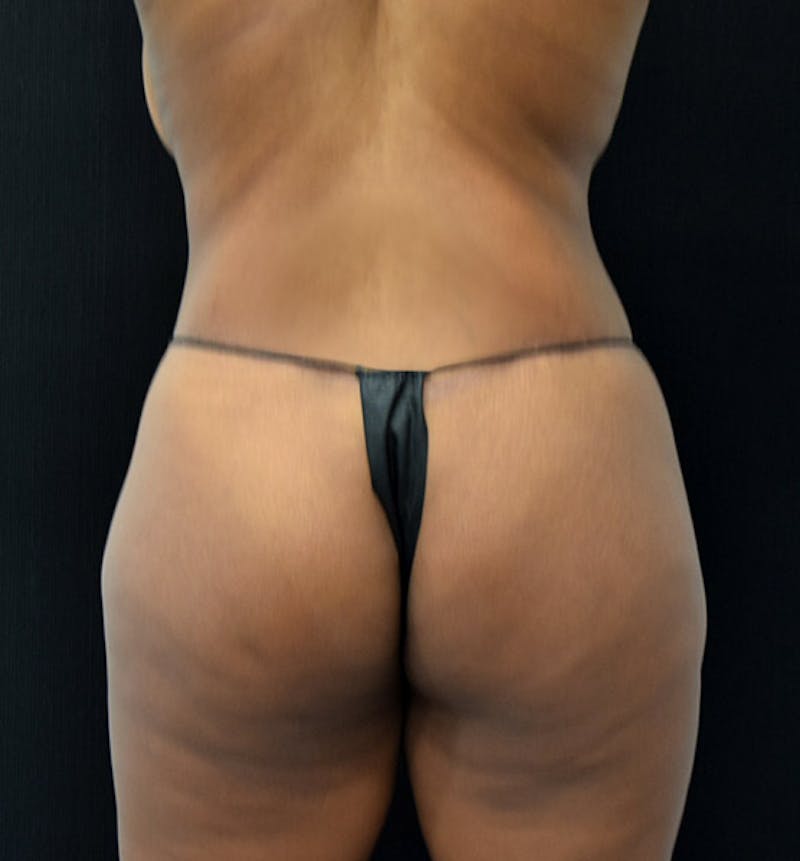 Lower Body Lift Before & After Gallery - Patient 102391249 - Image 8