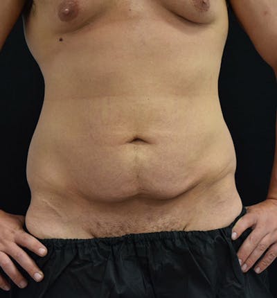 Male Lower Body Lift Before & After Gallery - Patient 148037519 - Image 1