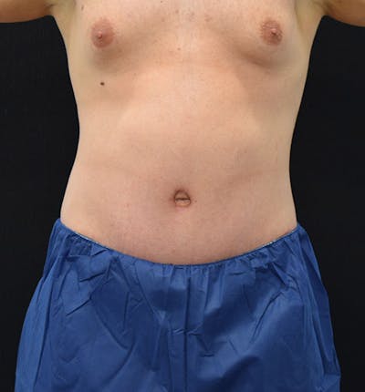 Lower Body Lift Before & After Gallery - Patient 148037519 - Image 2