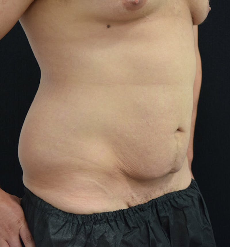 Male Lower Body Lift Before & After Gallery - Patient 148037519 - Image 3
