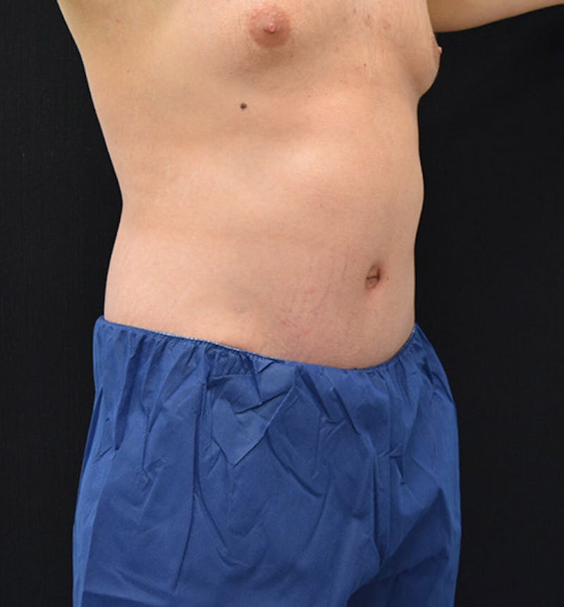 Male Lower Body Lift Before & After Gallery - Patient 148037519 - Image 4