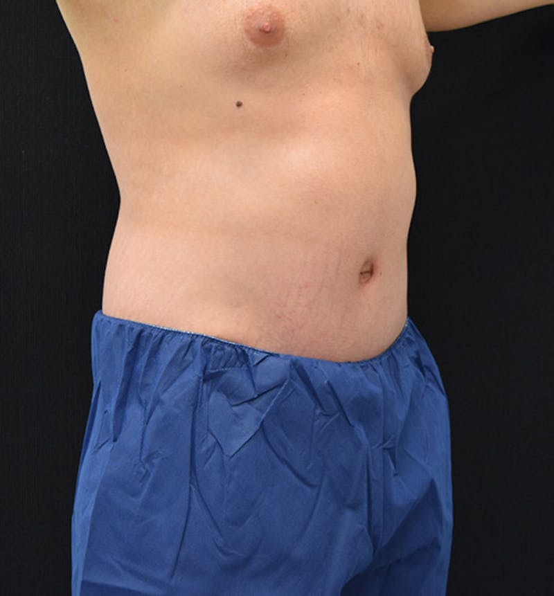 Lower Body Lift Before & After Gallery - Patient 148037519 - Image 4