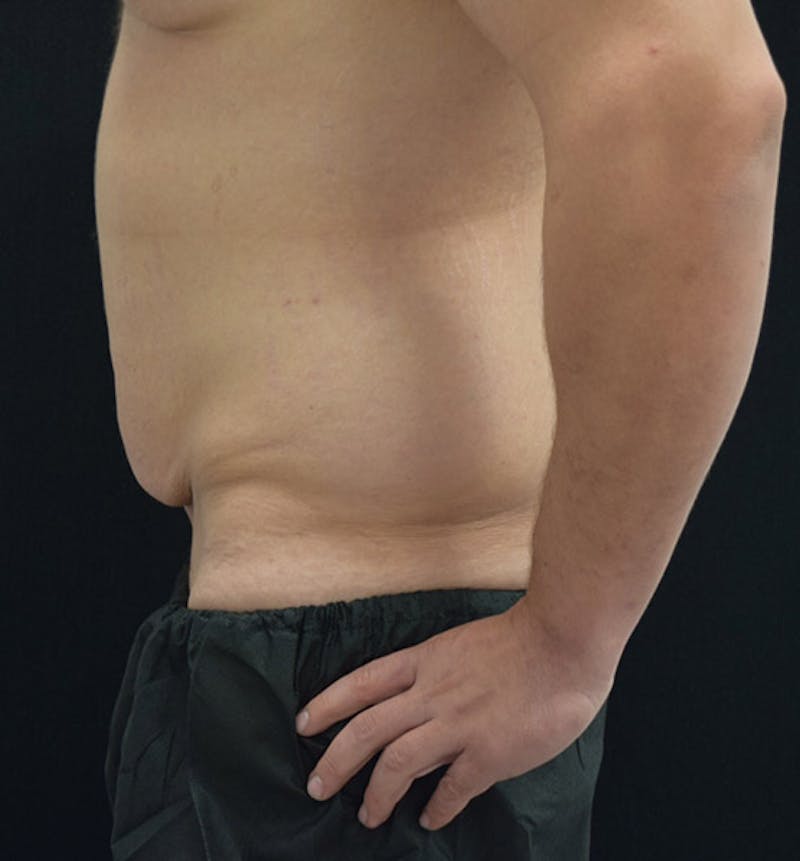 Male Lower Body Lift Before & After Gallery - Patient 148037519 - Image 5
