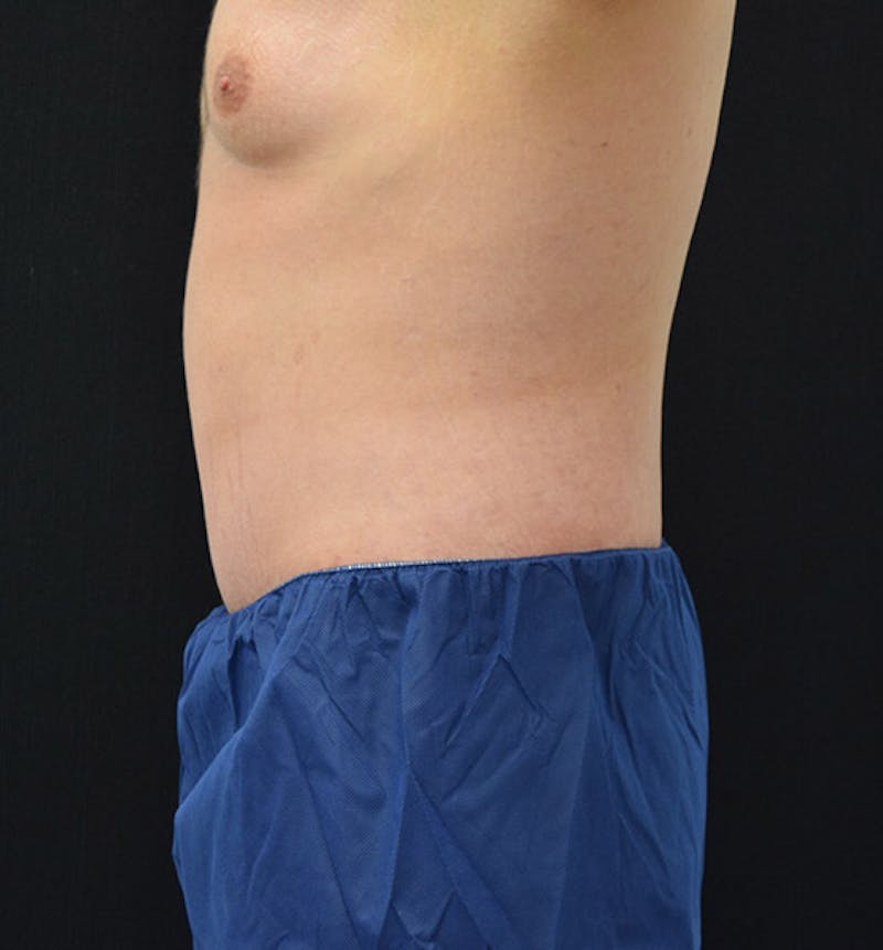 Lower Body Lift Before & After Gallery - Patient 148037519 - Image 6