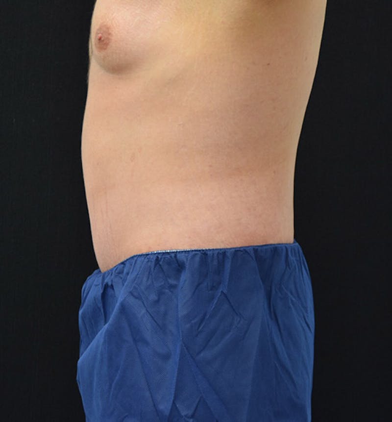 Male Lower Body Lift Before & After Gallery - Patient 148037519 - Image 6