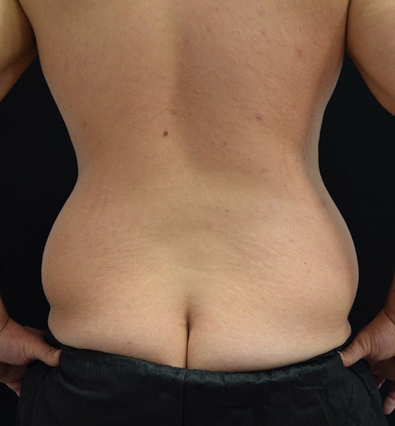 Male Lower Body Lift Before & After Gallery - Patient 148037519 - Image 7