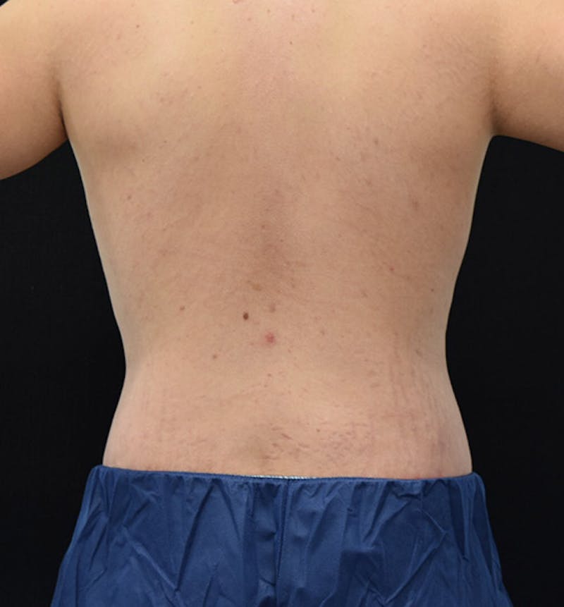 Male Lower Body Lift Before & After Gallery - Patient 148037519 - Image 8