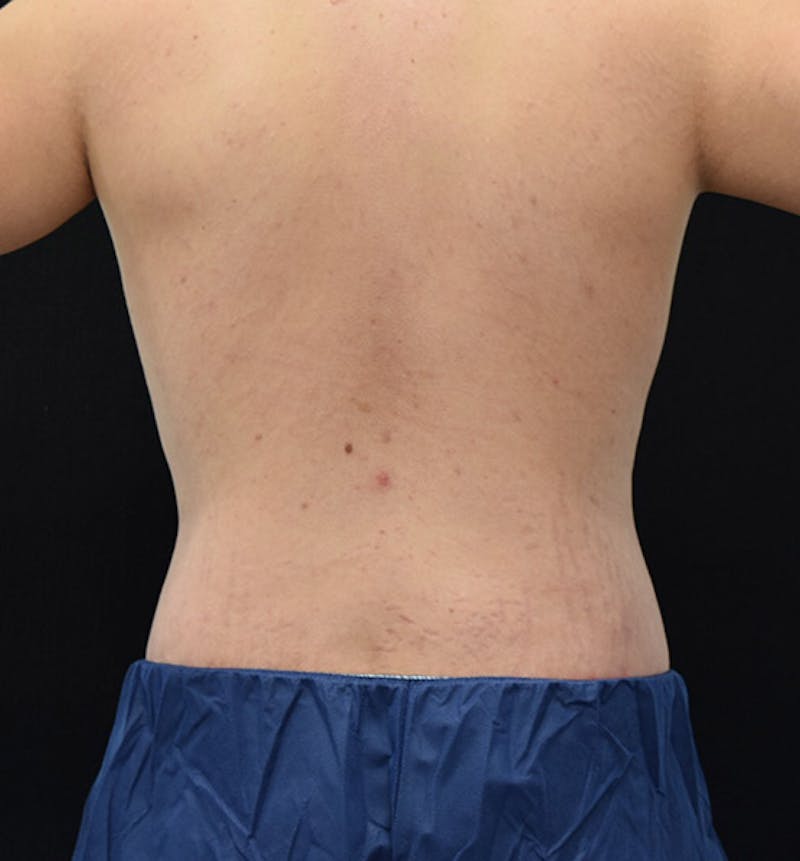 Lower Body Lift Before & After Gallery - Patient 102391307 - Image 8