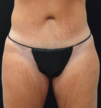 Lower Body Lift Before & After Gallery - Patient 102391342 - Image 2