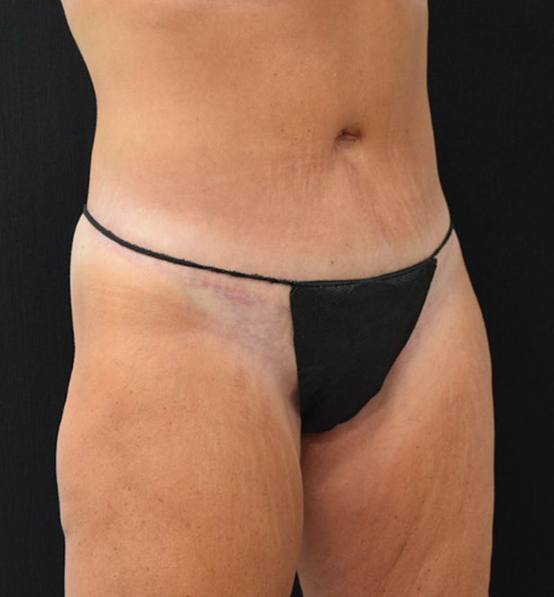 Lower Body Lift Gallery - Patient 102391342 - Image 4