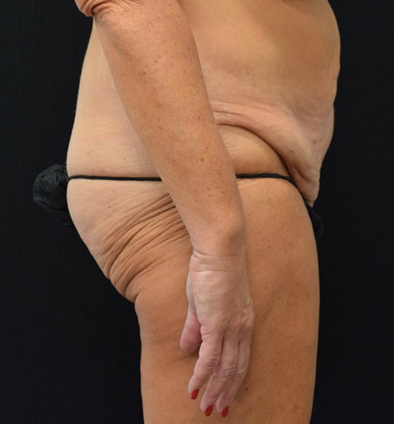 Lower Body Lift Before & After Gallery - Patient 102391342 - Image 5