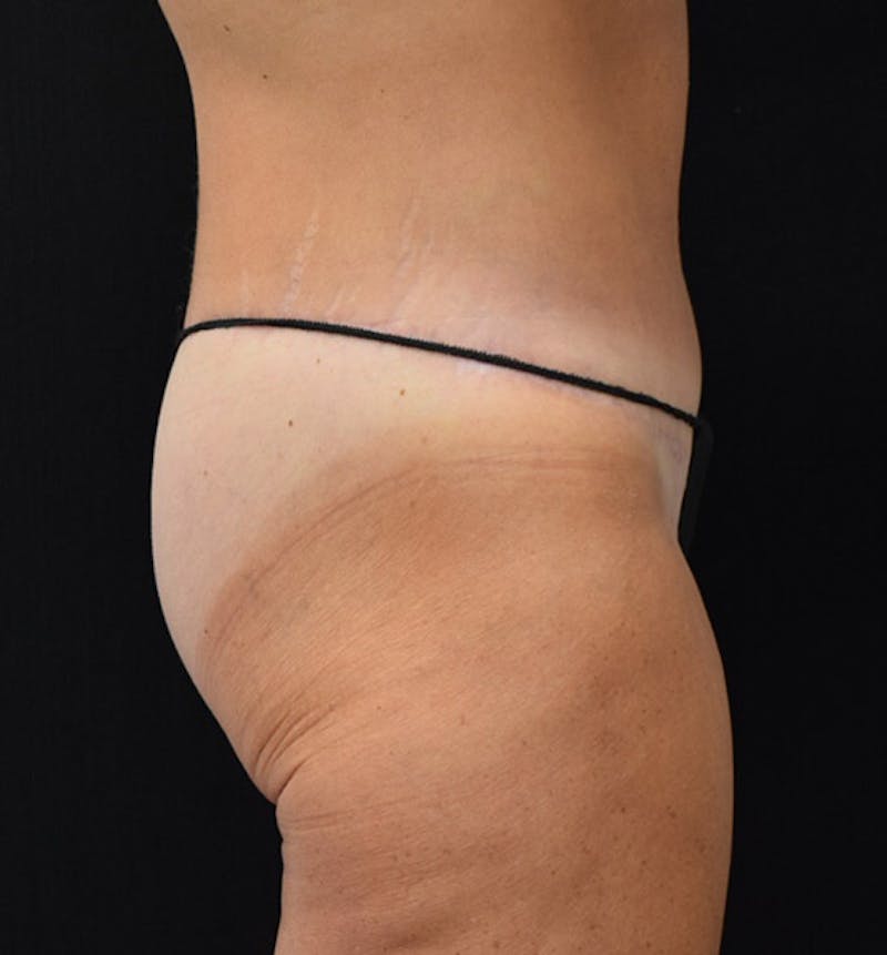 Lower Body Lift Before & After Gallery - Patient 102391342 - Image 6