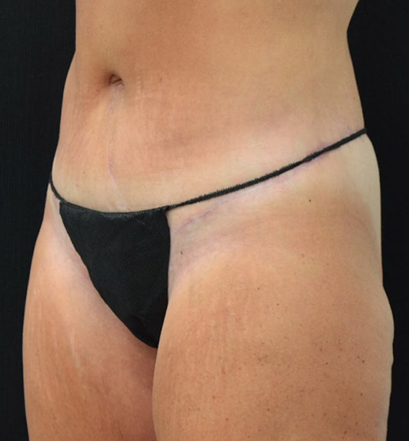 Lower Body Lift Before & After Gallery - Patient 102391342 - Image 8