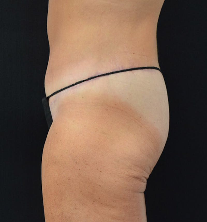 Lower Body Lift Before & After Gallery - Patient 102391342 - Image 10