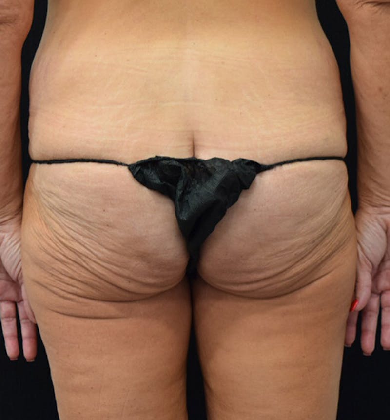 Lower Body Lift Before & After Gallery - Patient 102391342 - Image 11