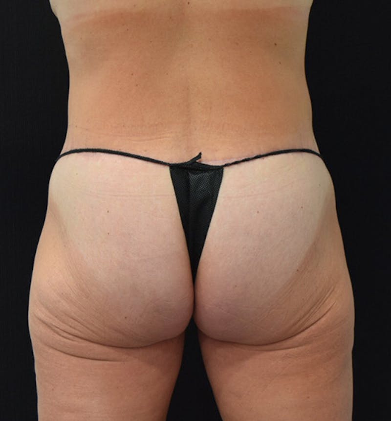 Lower Body Lift Gallery - Patient 102391342 - Image 12