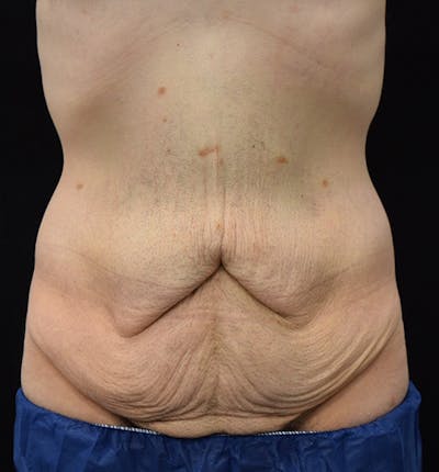 Male Lower Body Lift Before & After Gallery - Patient 148037520 - Image 1