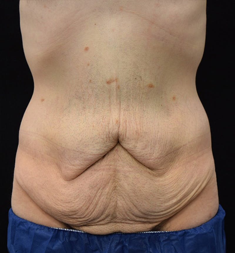 Male Lower Body Lift Before & After Gallery - Patient 148037520 - Image 1