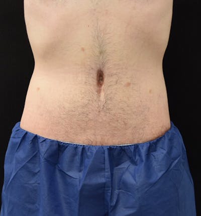 Male Lower Body Lift Before & After Gallery - Patient 148037520 - Image 2