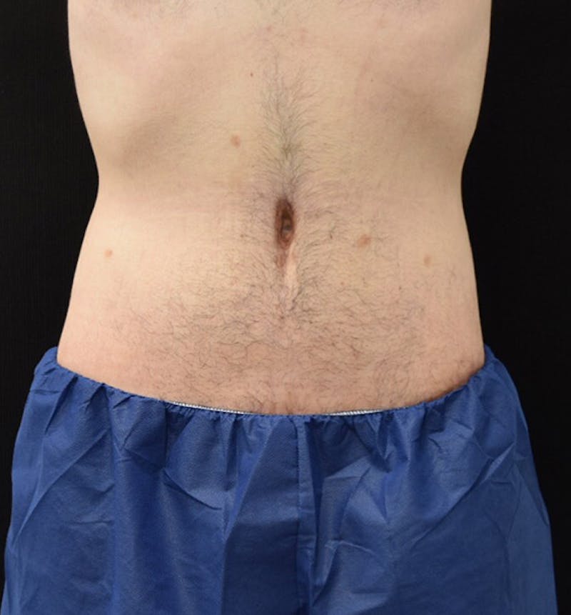 Male Lower Body Lift Before & After Gallery - Patient 148037520 - Image 2