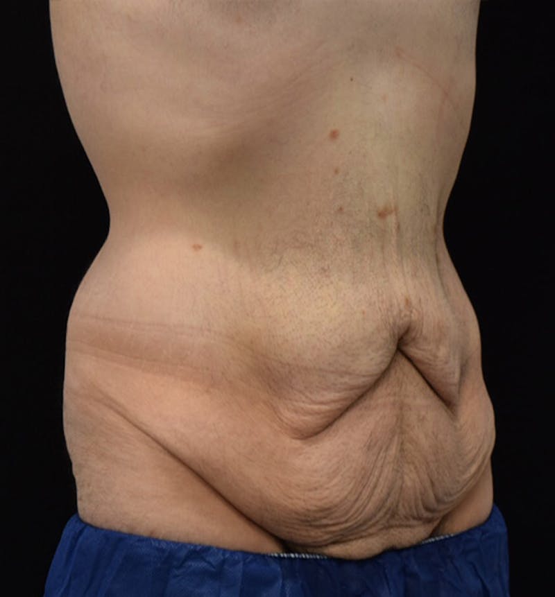 Male Lower Body Lift Before & After Gallery - Patient 148037520 - Image 3