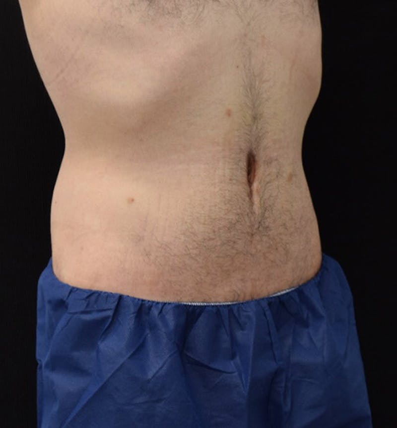 Male Lower Body Lift Before & After Gallery - Patient 148037520 - Image 4