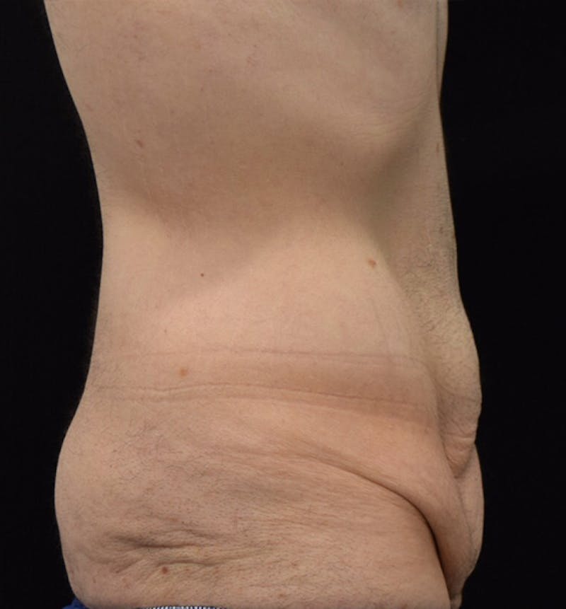 Male Lower Body Lift Before & After Gallery - Patient 148037520 - Image 5