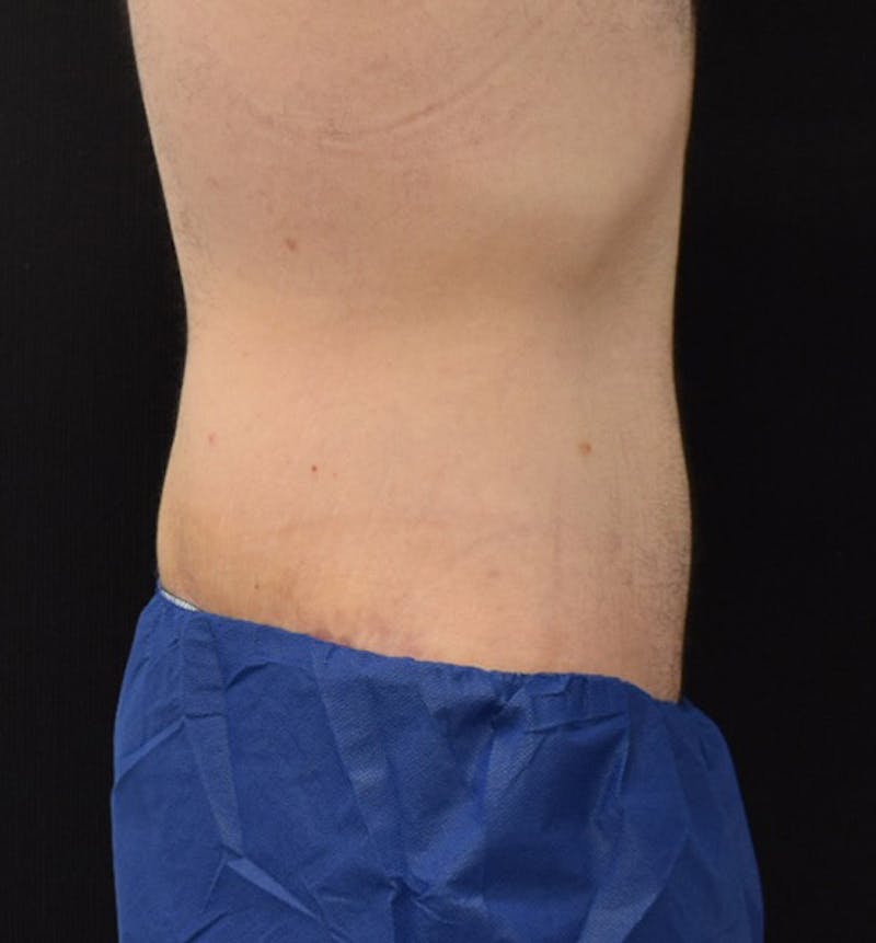 Lower Body Lift Before & After Gallery - Patient 148037520 - Image 6